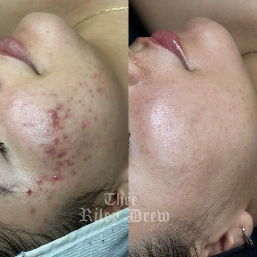 Thee Acne Clinic & Treatment Program